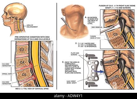 Spine Surgery C5 6 and C6 7 Disc Herniations with Spinal Cord Stock ...