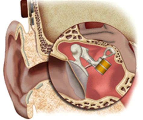 Middle Ear Implants - Gardner Audiology