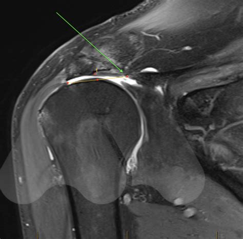 Rotator Cuff Tear MRI Images