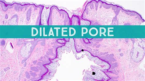 Dilated Pore of Winer: Dermpath in 5 Minutes (video) | KiKo XP