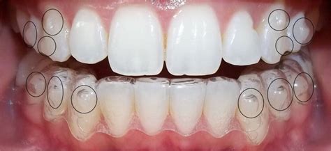 ATTACHMENTS In Clear Aligner | PRISTINE CLEAR ALIGNERS