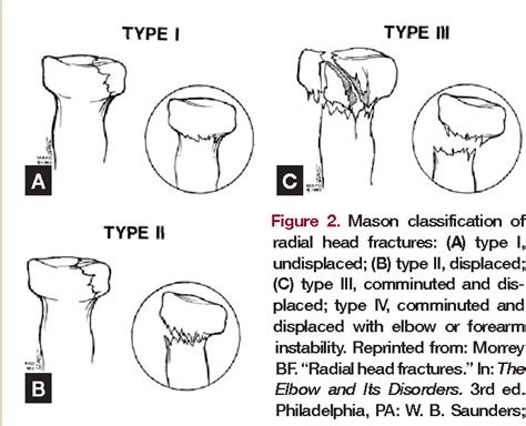 Radial Head Fracture Classification