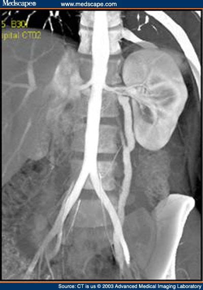 Evalution of the Left Gonadal Vein