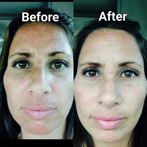 Salicylic Facial Peel | Bellissimo You Skin Care Tampa