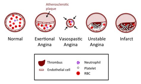 Stages Of Angina