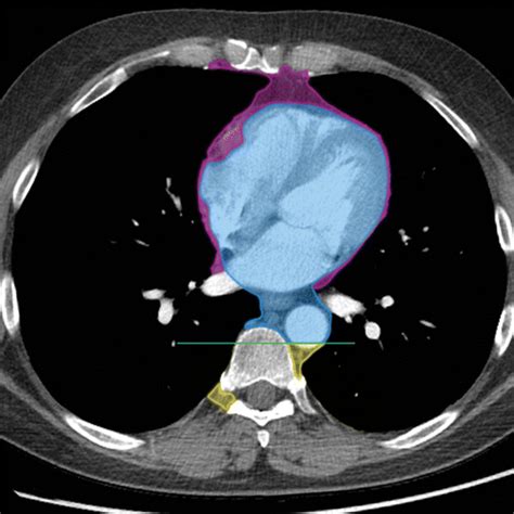 ITMIG Classification of Mediastinal Compartments and Multidisciplinary Approach to Mediastinal ...