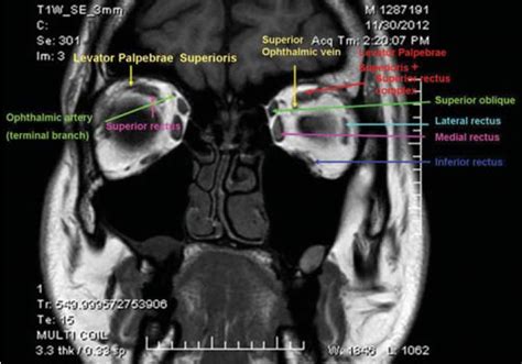 Orbit MRI Anatomy | Radiology Anatomy Images