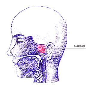 Nasopharyngeal Carcinoma Staging