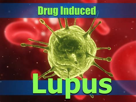 Drug-Induced Lupus - Medications Aggravating Your Lupus