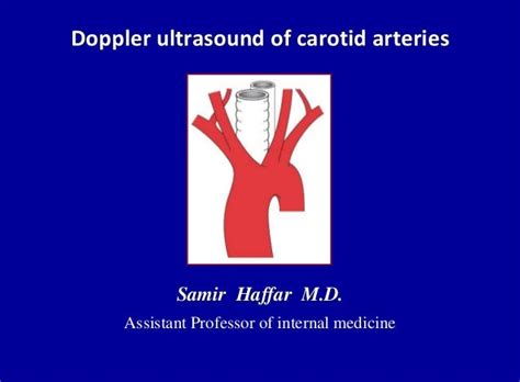 Doppler ultrasound of carotid arteries