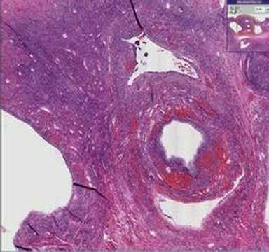 Histopathology Ovary- -Polycystic ovarian disease (Stein-Lev - YouTube