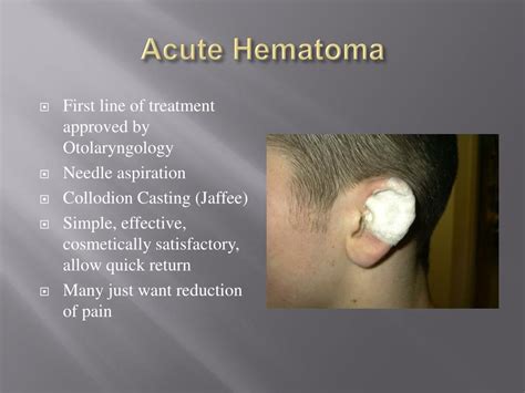 Auricular Hematoma Treatment