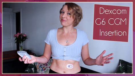 Dexcom G6 Sensor Insertion - YouTube