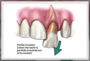 Avulsed Tooth: Symptoms and Treatment - Dentist Ahmed