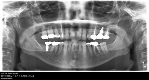 What is a Panoramic Dental XRay and What is it Used For?