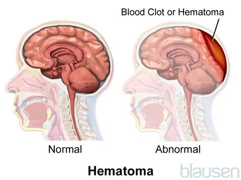 Intracranial Hematomas - Injuries and Poisoning - Merck Manuals ...