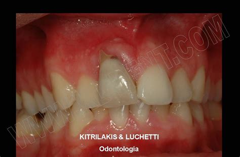 Kitrilakis & Luchetti - Dentistry: Dental Implant in Upper Central Incisor: Case 1