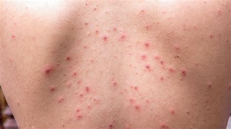 How to Prevent and Treat 8 Common Skin Conditions | Everyday Health