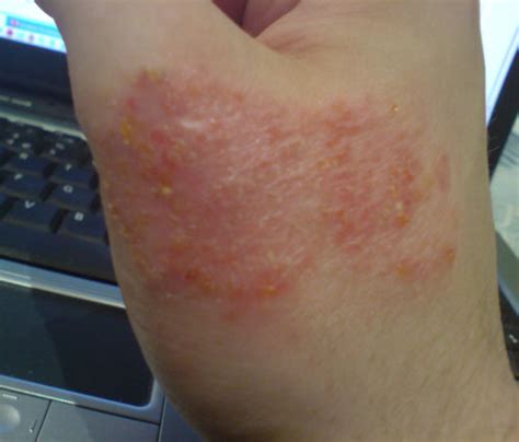 Eczema Symptoms Pictures - Eczema Treatment: Eczema Symptoms Pictures