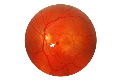 Macular Degeneration | Hot Sex Picture