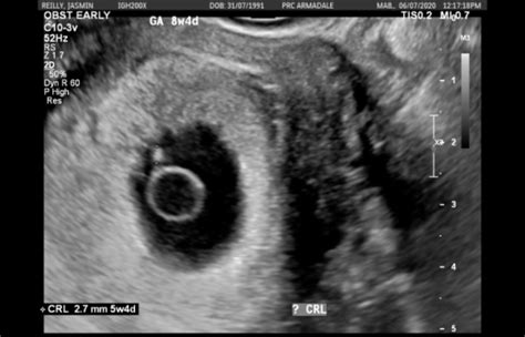 First ultrasound shows I’m 3 weeks behind | BabyCenter