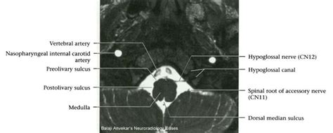 Dr Balaji Anvekar FRCR: Cranial Nerves MRI Planning Protocol