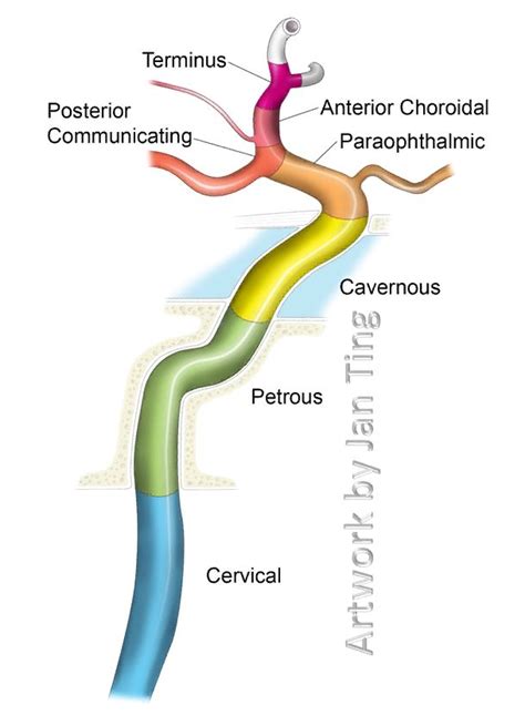 Internal Carotid Artery NYU Classification | Internal carotid artery, Carotid artery, Basic ...