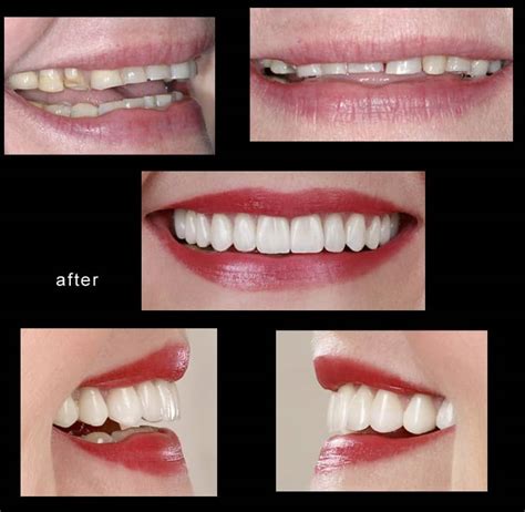 LUMINEERS VS VENEERS - Smile Design Dental Practice | Dentist in ...