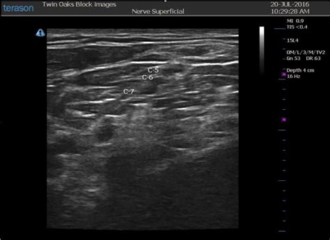 Interscalene Block — CRNA Conferences - Twin Oaks Anesthesia