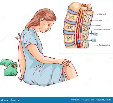 Epidural Nerve Block Injection Illustration Stock Vector - Illustration of anesthesia, vertebral ...