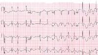 Acute Pericarditis