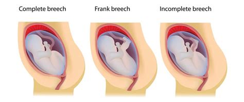 Normal Baby Position In Womb