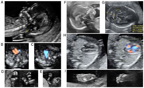 Early anomaly scan. (A) Isolated thickened nuchal translucency at 12... | Download Scientific ...