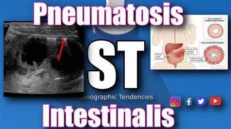 Pneumatosis Intestinalis - YouTube