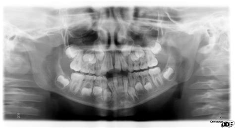 Baby Teeth Panoramic Xray | linkskadel