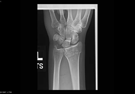 Fracture of distal ulna - Xray - radRounds Radiology Network