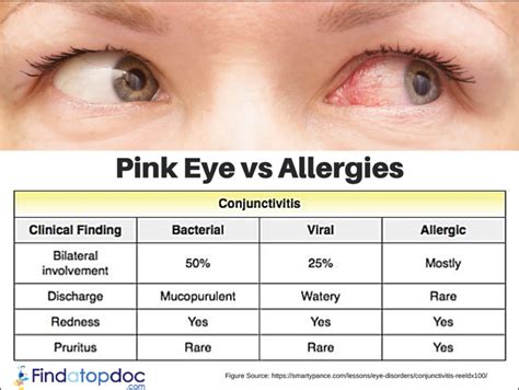 Pink Eye vs. Allergies: Causes, Symptoms, and Treatment