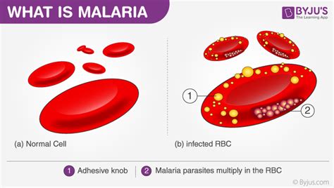 Malaria - Causes, Symptoms, Prevention and Life Cycle of Parasite