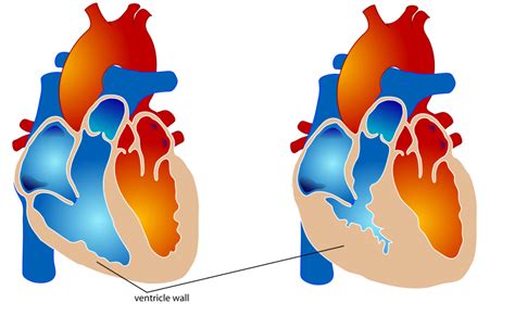 Right ventricular hypertrophy: Causes and complications