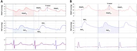 Pulmonary Artery Wedge Waveform