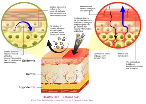 Skin_Barrier_diagram-Cons1-1200×834 | AproDerm®