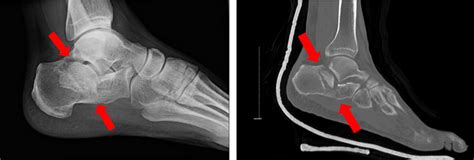 Fracture du calcanéum (fracture de l'os du talon) | ISNCA