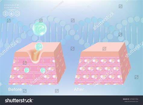 Hyaluronic Acid Before After Skin Solutions Stock Vector (Royalty Free) 1974831956 | Shutterstock