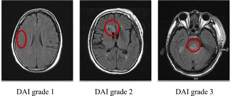 Frontiers | Cognitive impairment in diffuse axonal injury patients with ...