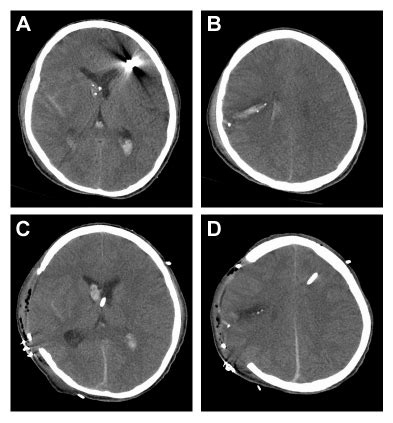 Axial CT scans showing example of brain herniation over bone edges due ...