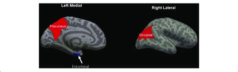 | Regions of significant cortical thinning (blue) and thickening (red)... | Download Scientific ...