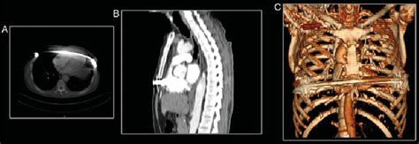 After reconstruction, the appearance of the Nuss bar in axial (A),... | Download Scientific Diagram