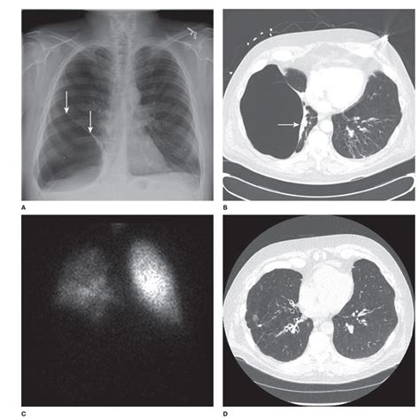 Bullous Disease of the Lung | Thoracic Key