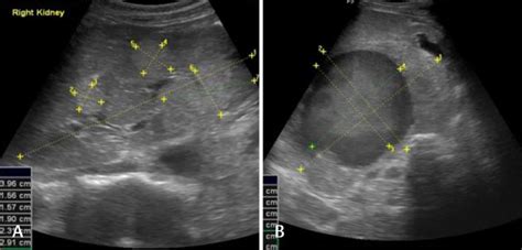 Ultrasound of a 24-year-old woman with bilateral renal angiomyolipoma ...