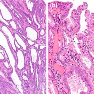 Histopathological findings of the duodenal tumor. a Low-power view. b... | Download Scientific ...